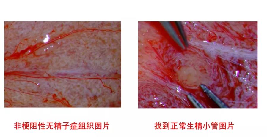 医学科普：揭开显微取精的神秘面纱